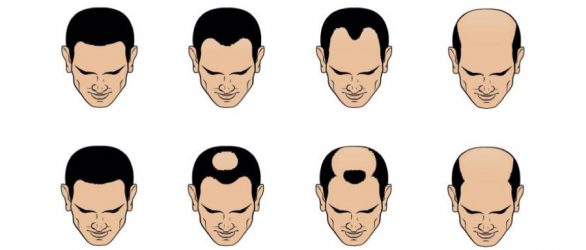 Norwood Scale: Hair Loss Stages - Drpilus Blog
