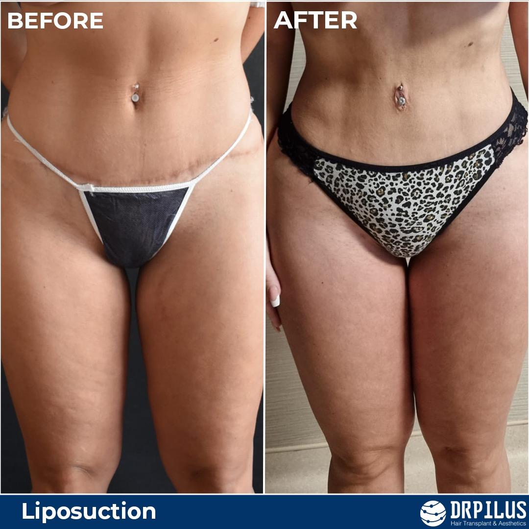 Liposuction