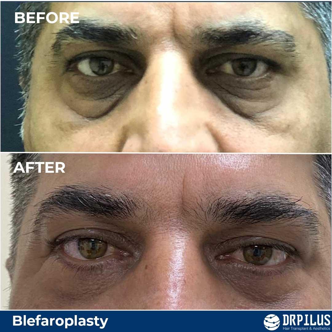 blepharoplastyba3