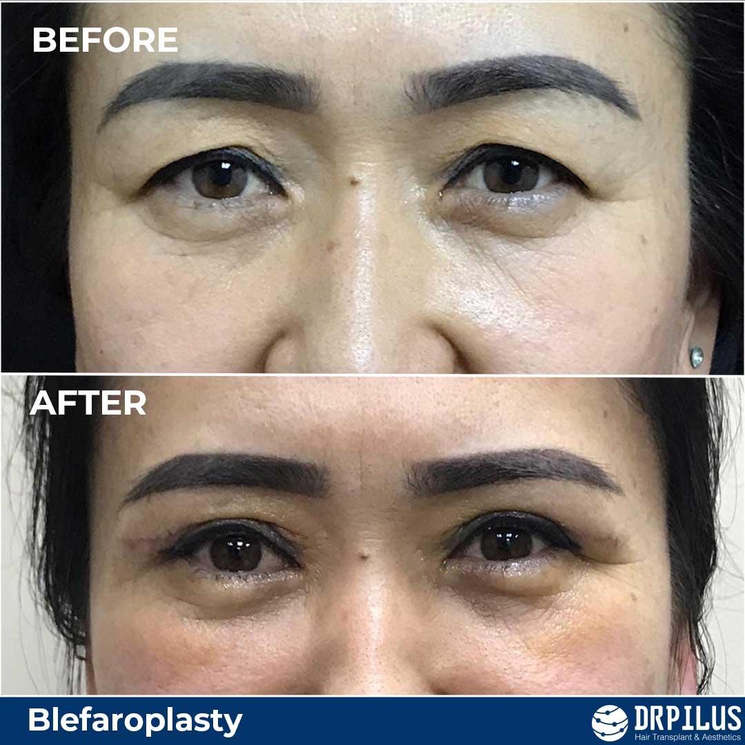 blepharoplastyba1