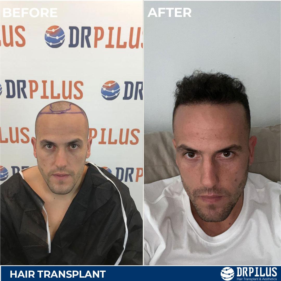 Fue Hair Transplant