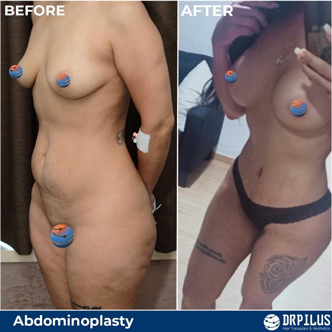 Abdominoplasty ba2