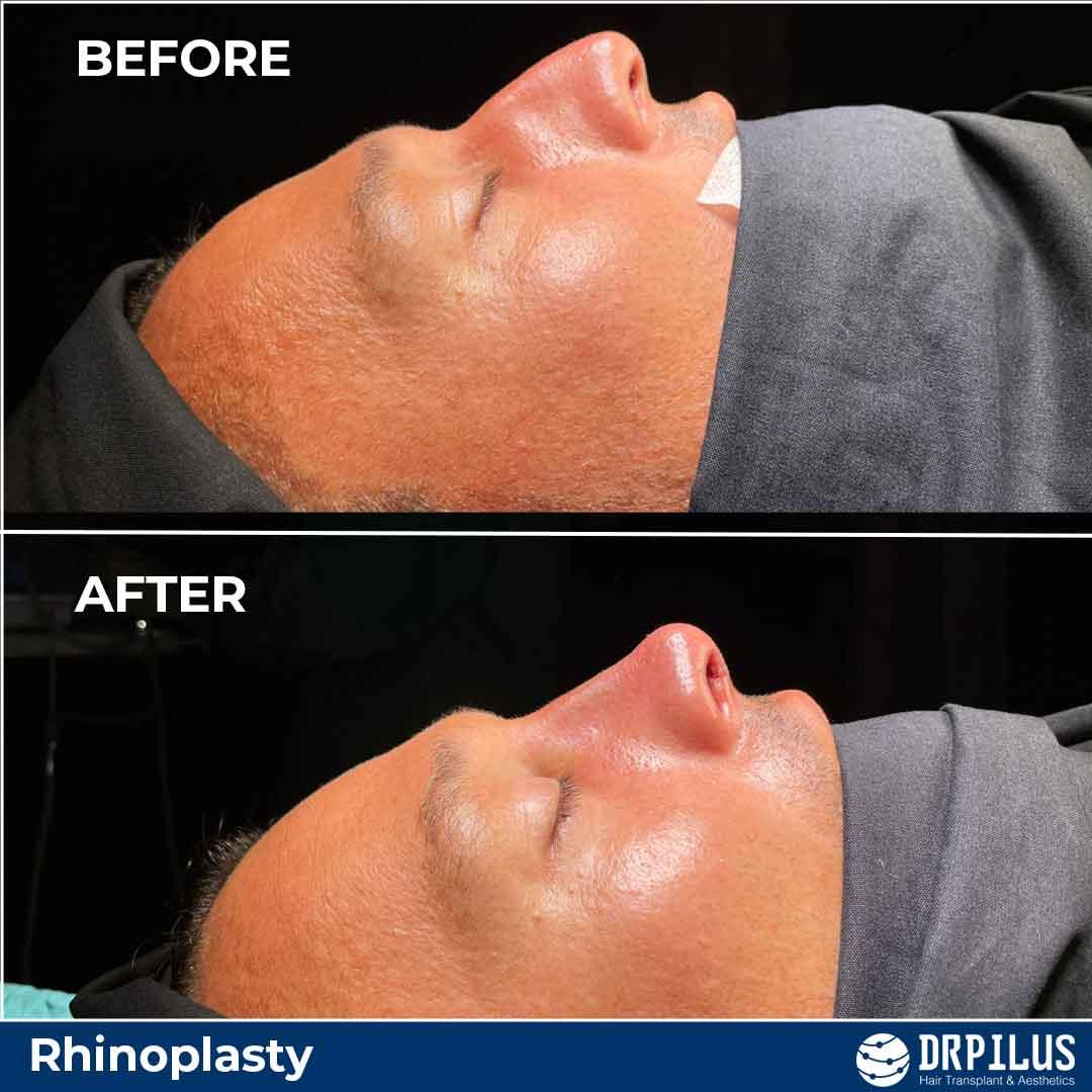 rhinoplastie
